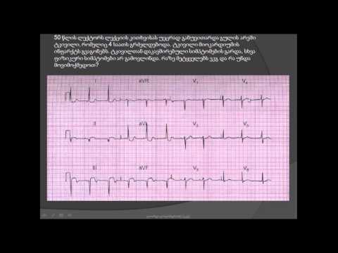 მიოკარდიუმის ქვედა კედლის მწვავე ინფარქტი (როგორ წავიკითხოთ ეკგ) / III და AVF ეკგ განხრები